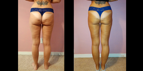 Before & After – Cellulite Reduction