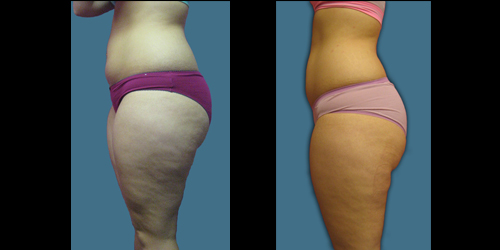 Before & After – Cellulite Reduction